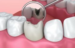 Điều trị và phòng ngừa sâu răng