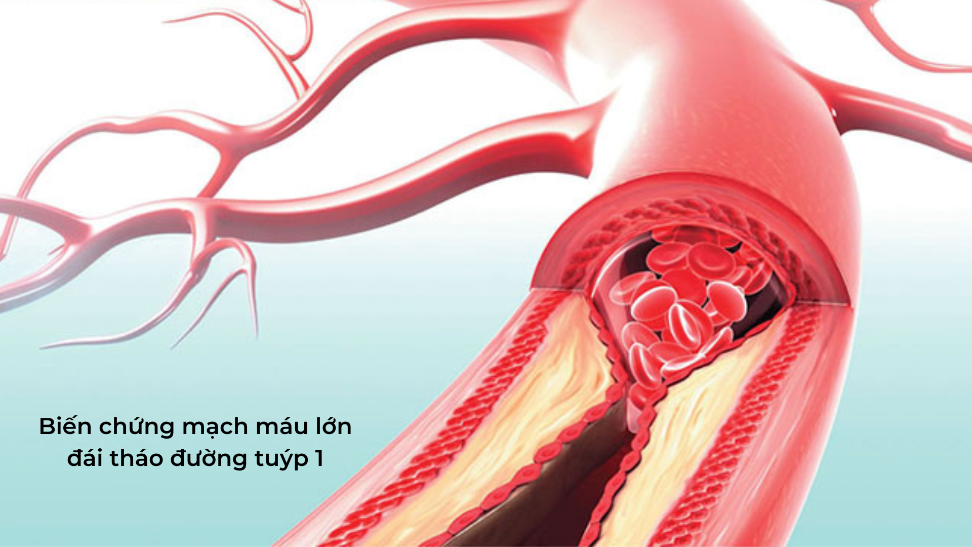 Biến chứng mạch máu lớn là biến chứng đái tháo đường tuýp 1 rất nguy hiểm