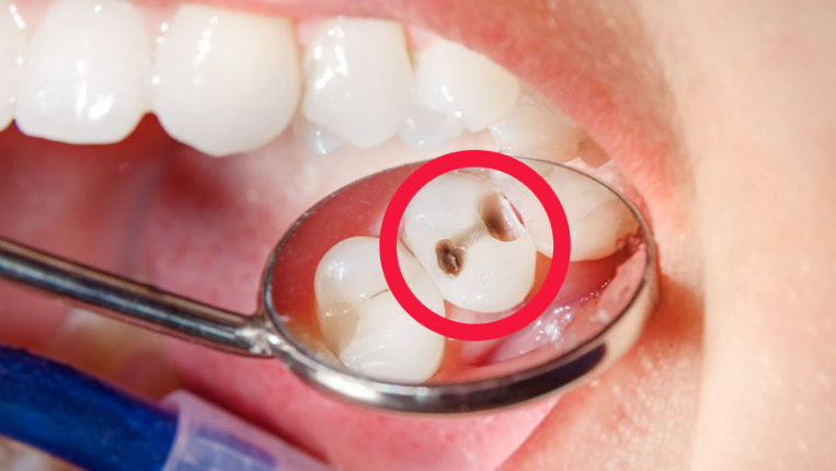 Sâu răng tạo môi trường thuận lợi cho vi khuẩn phát triển và gây viêm lợi