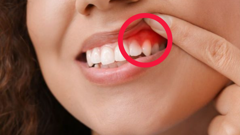 Viêm lợi có thể là một trong số các nguyên nhân gây chảy máu chân răng