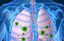 Nguyên nhân và cách phòng tránh bệnh viêm phổi
