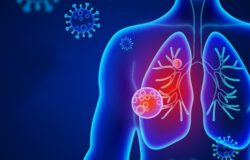 Viêm phổi là gì?