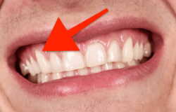 Điều trị và ngăn ngừa tụt nướu răng