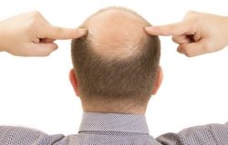 Nguyên nhân, giải pháp điều trị hói đầu ở nam giới