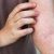 10 lý do hàng đầu lý giải nguyên nhân ngứa da