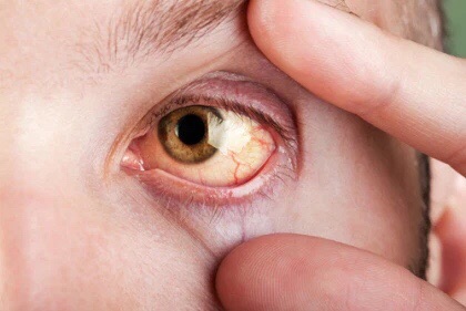 Triệu chứng vàng mắt ở bệnh nhân bị xơ gan 