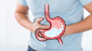 Đau bụng là dấu hiệu điểm hình của viêm loét dạ dày tá tràng