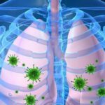 Nguyên nhân và cách phòng tránh bệnh viêm phổi